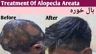 Treatment Of Alopecia Areata [upl. by Emlyn]