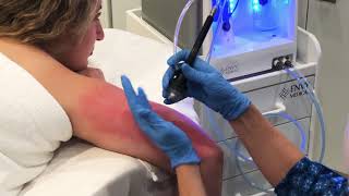 Dermalinfusion for KP Keratosis Pilaris [upl. by Cannice]