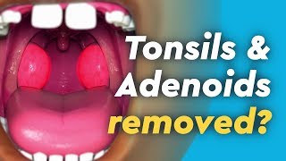 Tonsils and Adenoids Surgery [upl. by Chimene698]