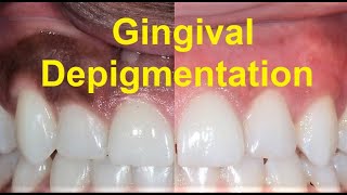 All about Gingival Pigmentation and Depigmentation [upl. by Ecirtap]