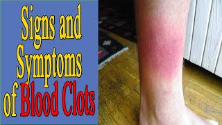 Signs and Symptoms of Blood Clots [upl. by Occer]