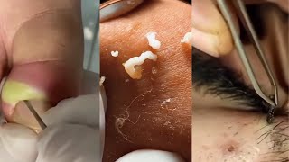 Unleashing Pimple Popper The Ultimate Satisfaction [upl. by Rainah]