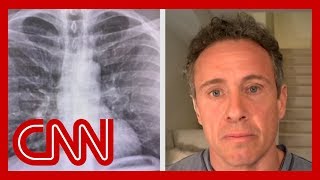 Chris Cuomo shares chest Xrays after coronavirus diagnosis [upl. by Avehs348]