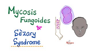 Mycosis Fungoides and Sèzary Syndrome  Hematology amp Oncology [upl. by Jochbed]