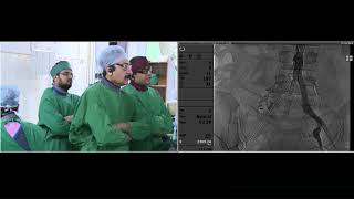 LiveCase  India Live  Dr N N Khanna Performing Endovascular Intervention Peripheral Angioplasty [upl. by Ulrikaumeko962]