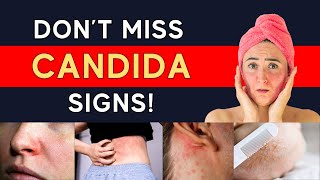 How To Identify Candida Overgrowth Test Options  Symptoms Especially lf You Have Skin Rashes [upl. by Ahtebbat494]