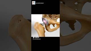 Total Hip Replacement Procedure  Animation [upl. by Naniac]