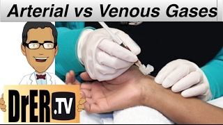 venous vs arterial blood gasses in the ER  medical minute [upl. by Mohl]