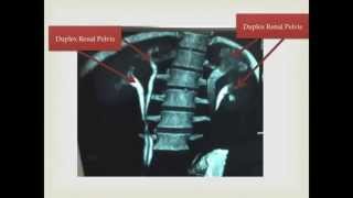 Congenital Anomaly Ureter Duplex and Duplex Renal Pelvis [upl. by Xer]