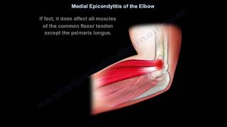 Medial Epicondylitis  Everything You Need To Know  Dr Nabil Ebraheim [upl. by Statis]