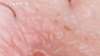 infected ingrown hair removal [upl. by Beale340]