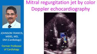 Jet Direction and the Mechanism of Mitral Regurgitation [upl. by Zachar342]