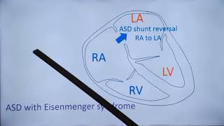 Important Complications of Eisenmenger Syndrome [upl. by Guild]