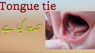 What is Tongue Tie Tandwa Tongue tie treatment in UrduHindi [upl. by Berne]