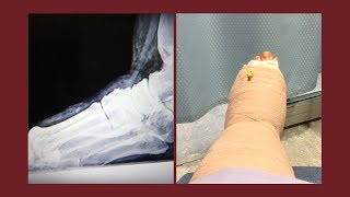 My Midfoot Fusion Surgery Part 5 [upl. by Januarius]