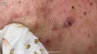 Big Cystic Acne Blackheads Extraction Blackheads amp Milia Whiteheads Removal Pimple Popping [upl. by Pharaoh]