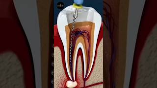 Root Canal Treatment science sciencefacts [upl. by Knipe889]