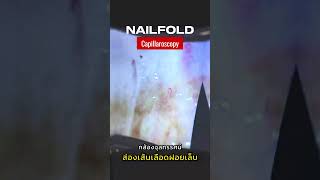 ส่องเส้นเลือดฝอย บริเวณโคนเล็บ ด้วยกล้องจุลทรรศน์ Nailfold Capillaroscopy [upl. by Airdnaxela]