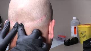 Micro Hair Pigmentation MHP van FUT litteken bij Beauty Care Nederland BCN te Katwijk [upl. by Maisey]