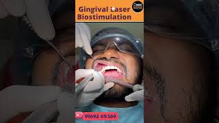 Laser Treatment For Gums Unlocking The Power Of Gingival Laser Biostimulation  shorts [upl. by Aleda]