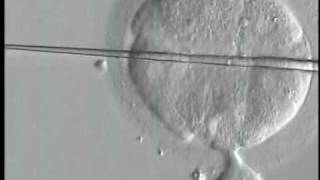 Human embryo  biopsy procedure by displacement method PGDPGSmpg [upl. by Suivatra]