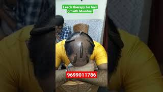 Leech therapy for hair growth Mumbai kzhijama shorts reels viral leechtherapy [upl. by Ayekat]