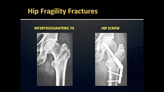 Fragility Fractures [upl. by Iuq]