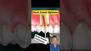 Top 4 Root Canal Alternatives You Should Know dentallan dentist shorts [upl. by Botsford]