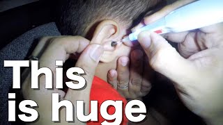 Massive Earwax Removed From Little Boys Ear [upl. by Eserehs685]