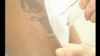 Laser Tattoo Removal on Dark Skin with the MedLite [upl. by Elatnahc]