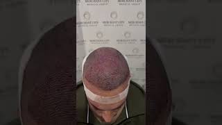 Hair Transplant Transformation 3800 Grafts [upl. by Francois]