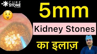 5mm Kidney Stone का इलाज  Treatment for 5 mm Kidney stones in Hindi  RIRS for 5mm Stone rirs [upl. by Meggi907]