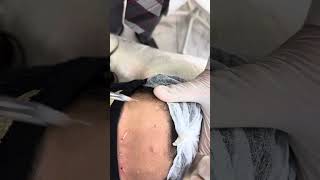 Technique for injecting botox  microbotox [upl. by Rechaba]