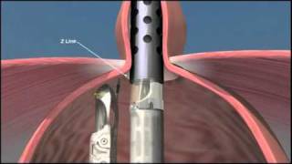 Acid Reflux Surgery TIF Incisionless Fundoplication Procedure [upl. by Tiram]