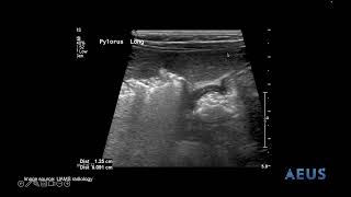 Pyloric Stenosis NLS Video [upl. by Trahern]