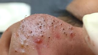 Big Cystic Acne Blackheads Extraction Blackheads amp Milia Whiteheads Removal Pimple Popping  1333 [upl. by Hook]