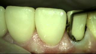 Gingival retraction [upl. by Gerge]