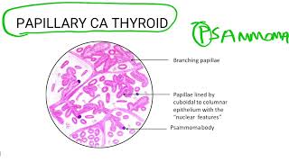 psammoma body  inicet neet pg  ARBORVITAENXT [upl. by Trebleda]