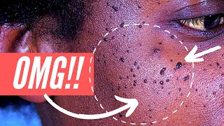 Why am I getting so many moles on my FACE Dermatosis Papulosa Nigra explained [upl. by Annoved907]