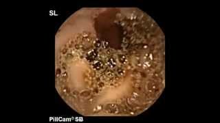 Active bleeding of the jejunum detected by capsule endoscopy [upl. by Aleyam]