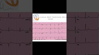 Cómo Identificar el Síndrome de WPW en un Electrocardiograma  Dr José Mario Porto [upl. by Petr474]