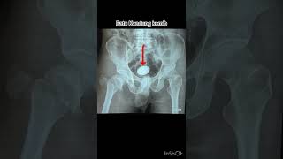 Batu kandung empedu vesicolith amp fraktur femur xray radiology röntgen [upl. by Naresh]