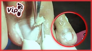 OVERGROWN INFECTED INGROWN TOENAIL REMOVAL [upl. by Nimsay159]