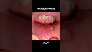 Aphthous Ulcer Time Lapse From Development to Healing Cold Sore [upl. by Nalani]