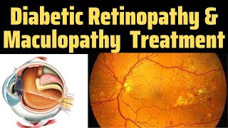 Diabetic Retinopathy Optos  Drss Eye  Diabetic Retinopathy Treatment  Maculopathy Treatment [upl. by Normak780]