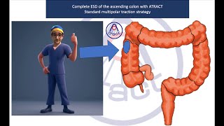 Complete ESD caecum procedure with adaptive traction [upl. by Sieber]