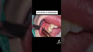 TOOTH ABSCESS Incision amp drainage [upl. by Anauqed776]