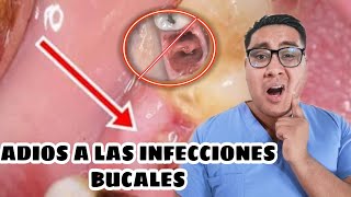 ¿COMO PUEDES PREVENIR LA ALVEOLITISINFECCION DESPUES DE UNA EXTRACCION DENTAL [upl. by Ivel]