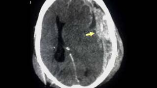 Acute subdural haematoma [upl. by Vladi]