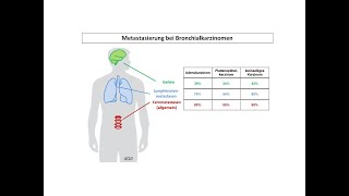 Metastasierung bei Bronchialkarzinomen  Strahlentherapie Prof Hilke Vorwerk [upl. by Aramahs]